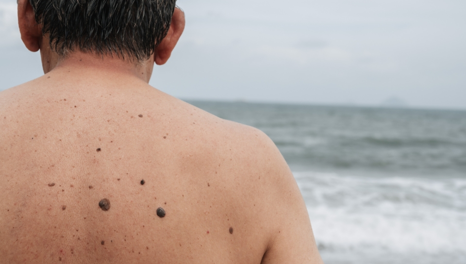 Pr&eacute;vention et d&eacute;pistage du m&eacute;lanome