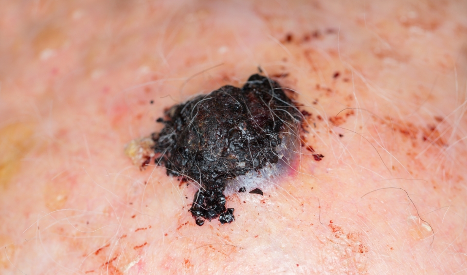 &Eacute;volution et pronostic du m&eacute;lanome