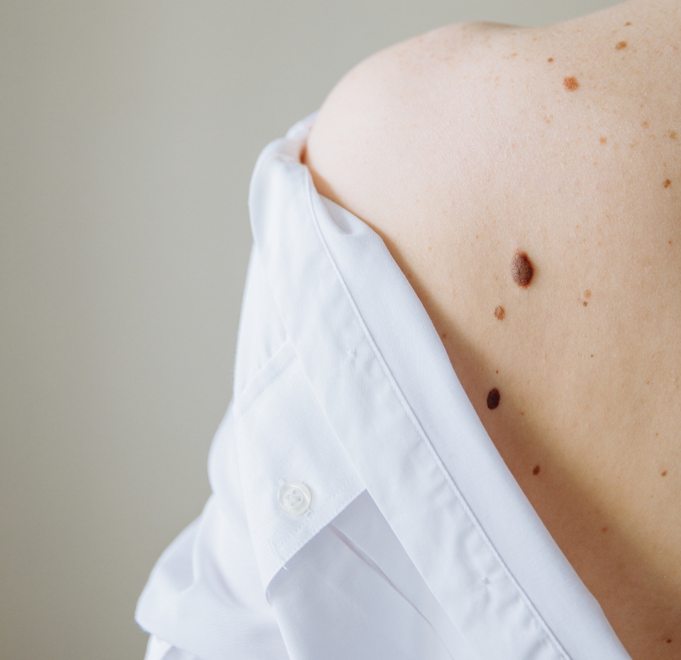 Chirurgie dermatologique du m&eacute;lanome &agrave; Lyon