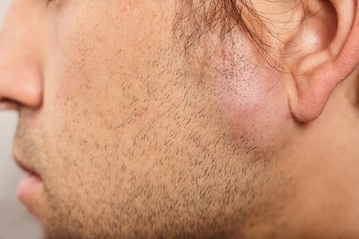 Chirurgie du lipome &agrave; Lyon