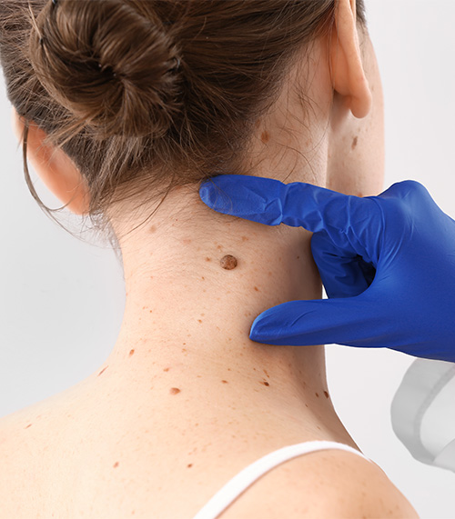 d&eacute;pistage cancer de la peau