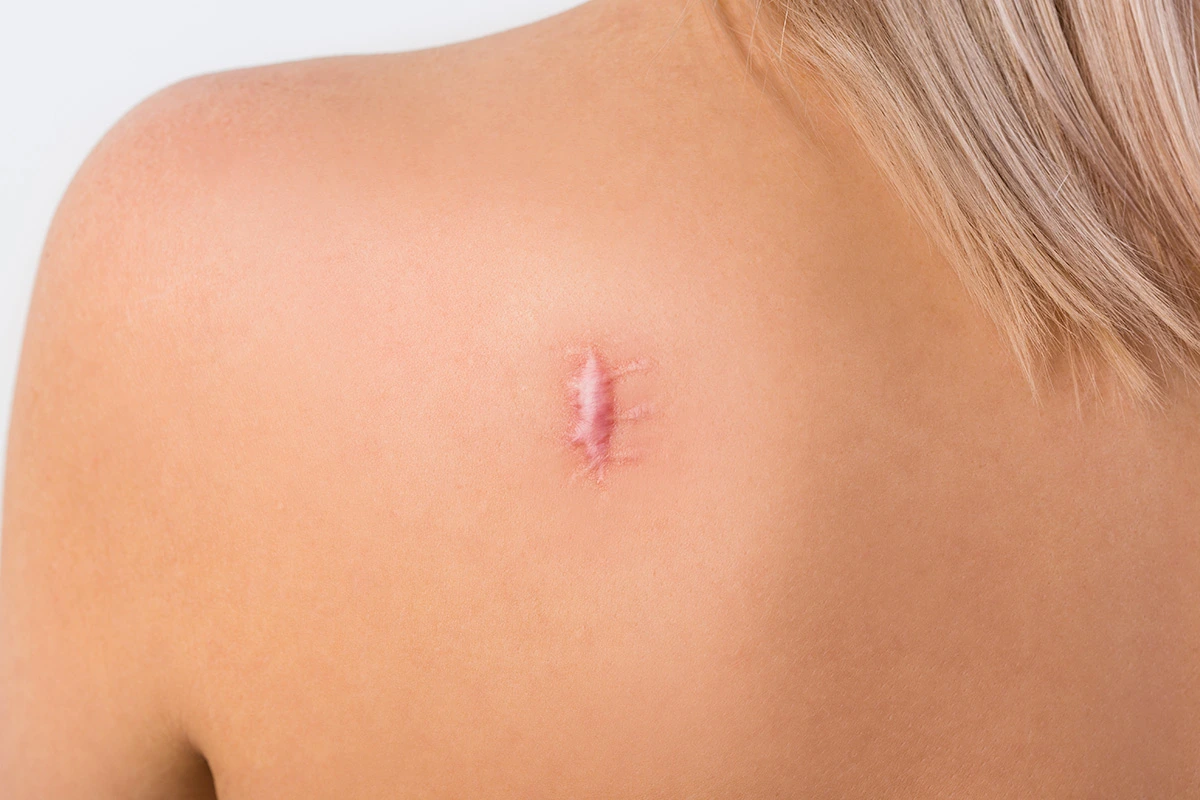 Cicatrices ch&eacute;lo&iuml;des