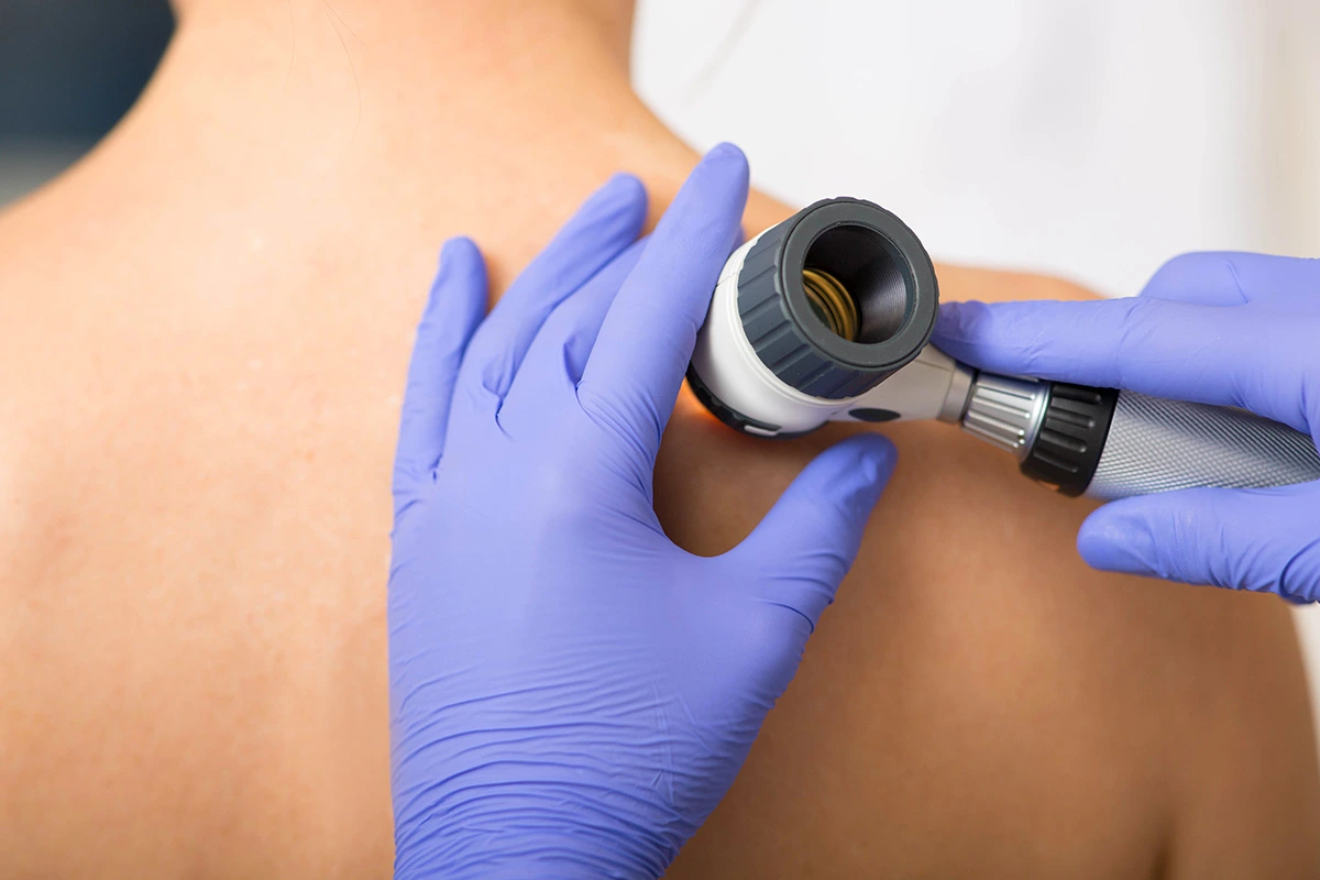 d&eacute;pistage cancer peau