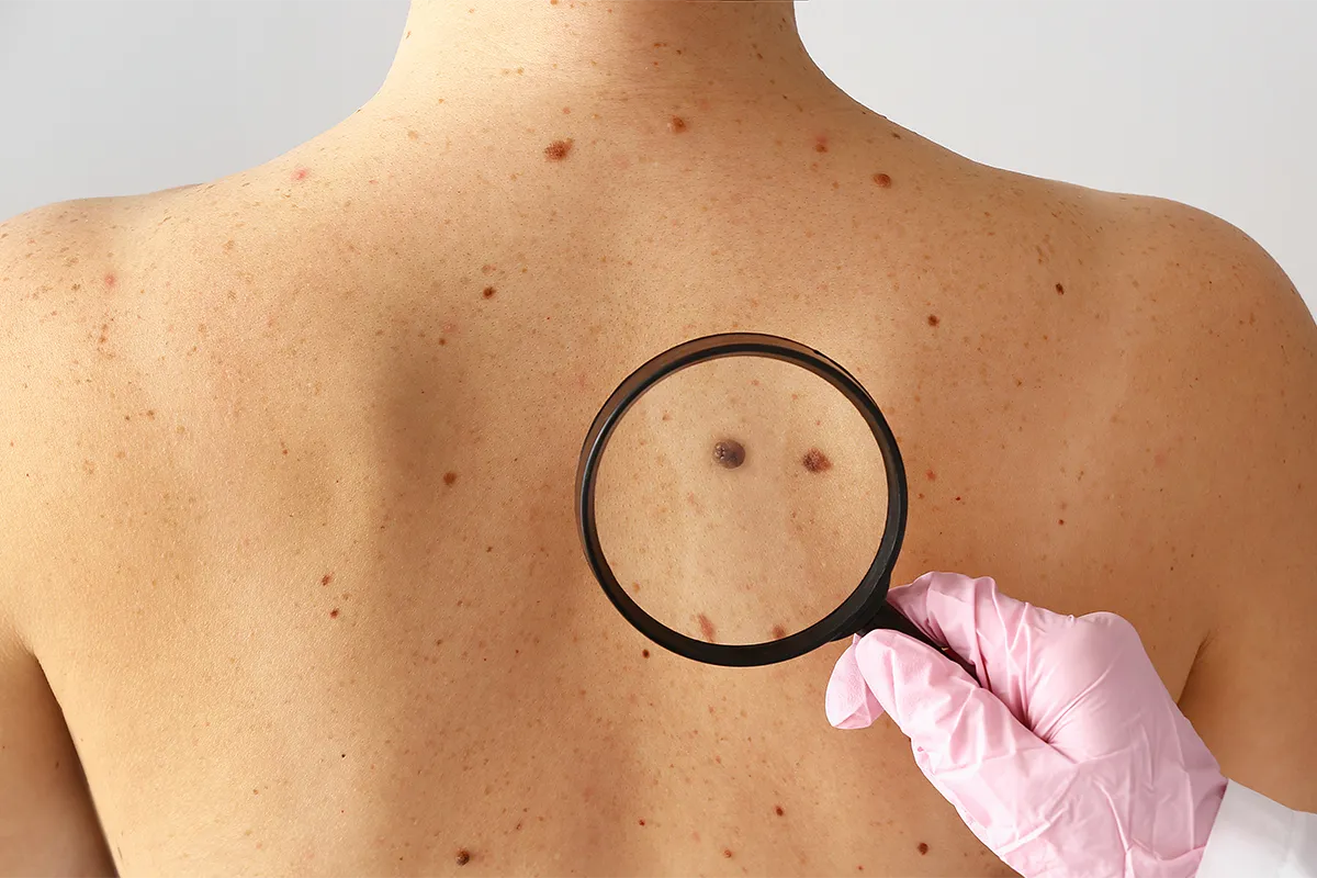 Examen dermatologique des grains de beaut&eacute; sur le dos avec loupe