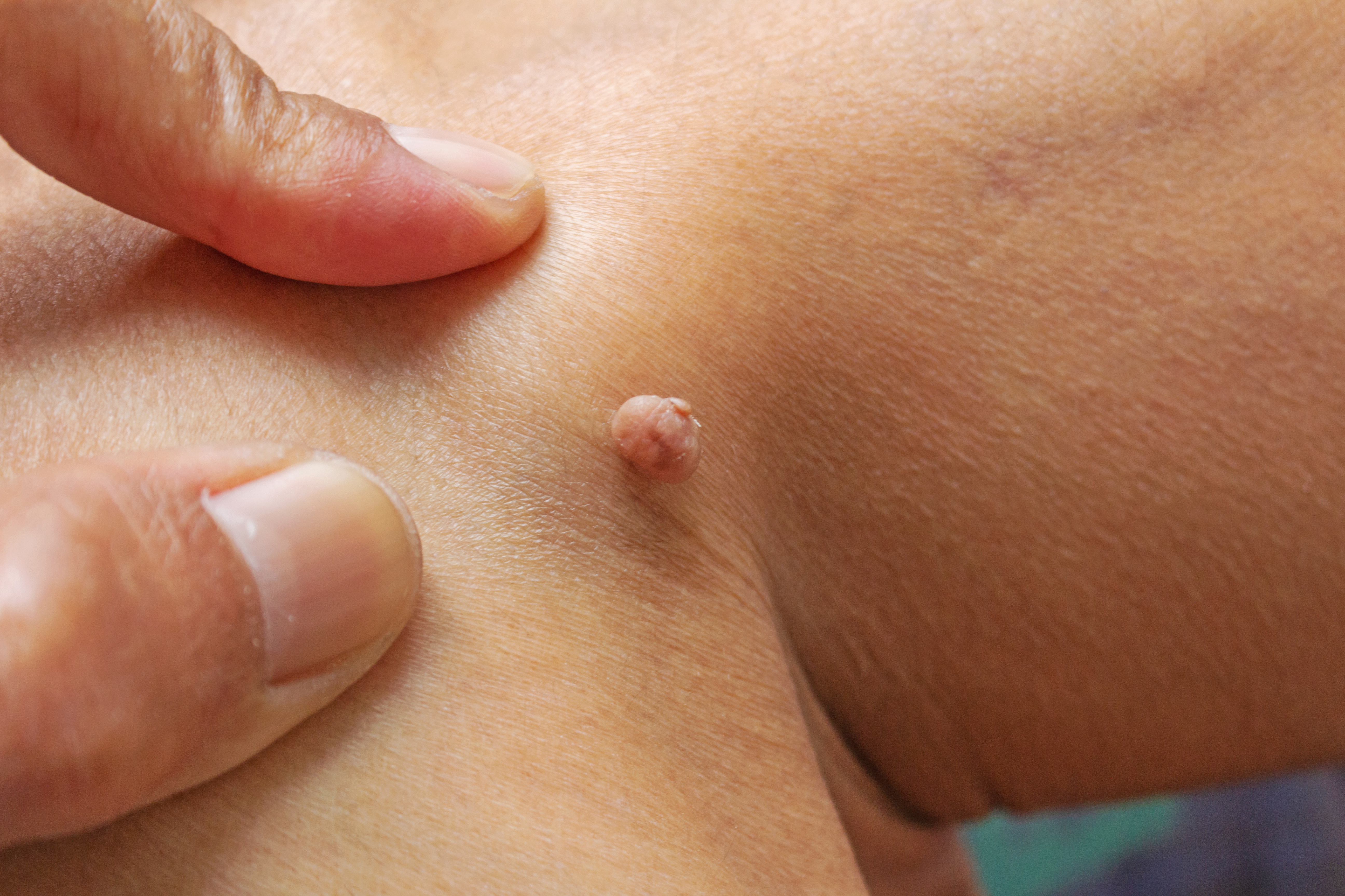 Examen cutan&eacute; au dermatoscope avant le retrait chirurgical d'un acrochordon ou d'une t&eacute;tine de peau &agrave; Lyon par DermoSURG