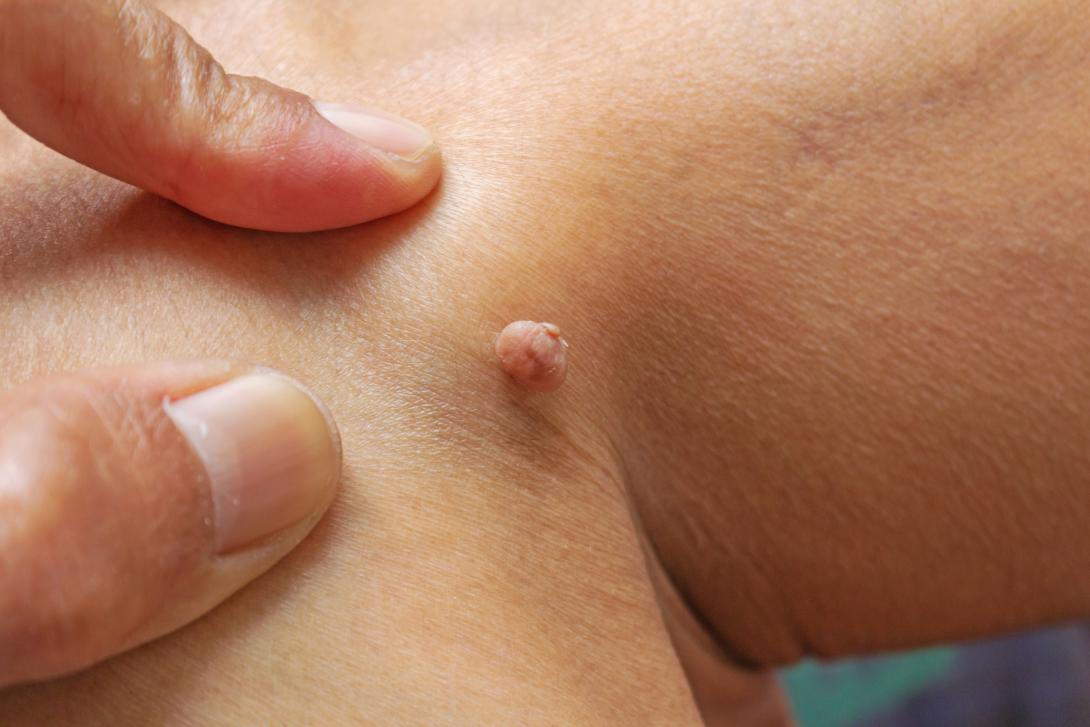 Examen cutan&eacute; au dermatoscope avant le retrait chirurgical d'un acrochordon ou d'une t&eacute;tine de peau &agrave; Lyon par DermoSURG